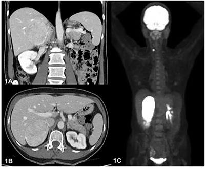 Oncocytic Adrenocortical Neoplasm with Concomitant Papillary Thyroid Cancer